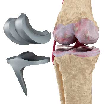 Orthopädie-Spezialisten für das Kniegelenksprothesen